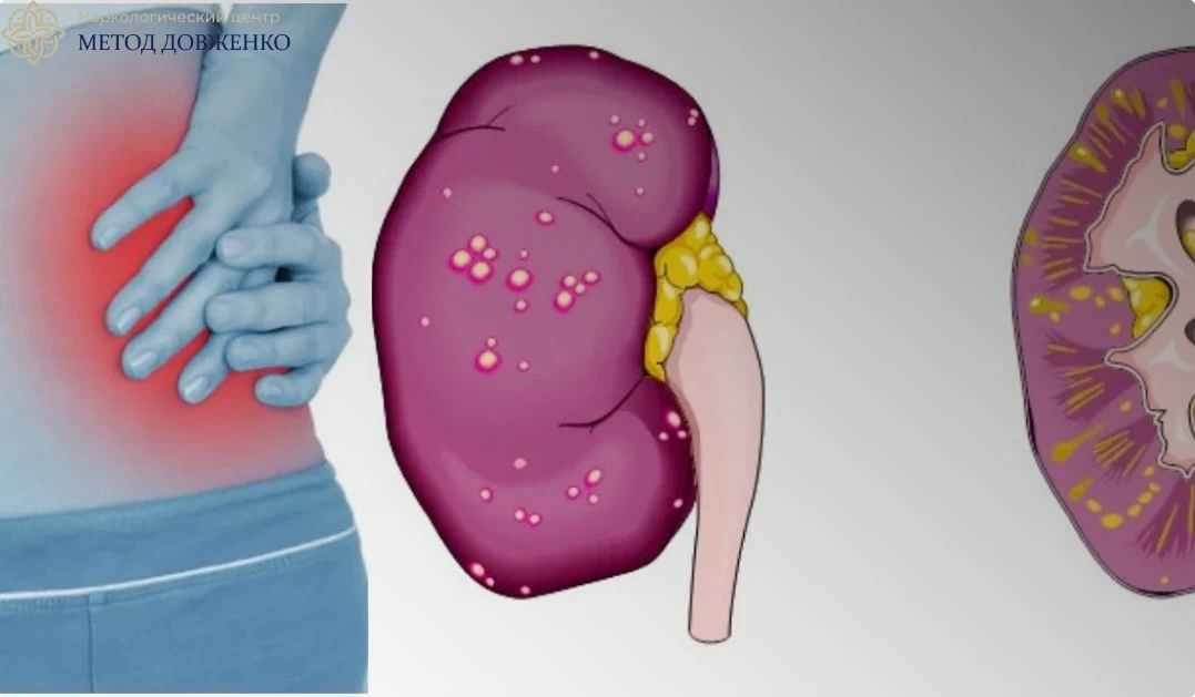 почки здорового и больного 
